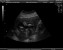Girl Ultrasound Photo